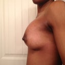 Post op day 2