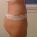 4 weeks post op