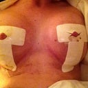 going into second week after bandage changed