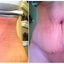PO Day 22 - you can see the area above belly button that will have to be fixed