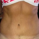 Scar one year
