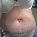 One week post op. Standing pretty straight