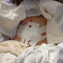 Immediately post-op