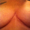 center scar, 3.5 months out