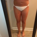 1 week post Front mostly swollen