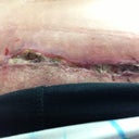open incision
