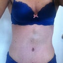 PO 2 weeks.  Have this lump above the BB and is still really bruised