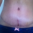 Pleased with the incision so far.  I thought the T part would be longer anyway.  Hope it eventually blends in with the other stretch marks still below BB