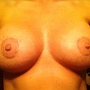 1 month post op! 34 DD