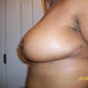 2 Week Post Opt