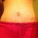Day 12 Post Op.  Morning Pic