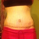Day 12 Post Op.  Scar healing well.  Like it low.