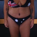 My tiny bikini i bought the day i started my diet, this is about day  post op, still very swollen, but still sooo happy