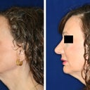 Had the surgery done March 2012, it took me a while to post a photo. Very happy with how much smaller my nose is