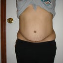 4 months post revision on left side (front View)