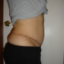 4 months post revision  on left side (right view)