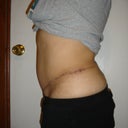4 months post revision on left side (left view)