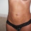 Front pic after 5 days