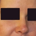 6 month post op front view. It looks much better than my original nose and especially my first rhinoplasty nose. I'm so happy that I had the courage and resources to get a revision rhinoplasty w/ Dr. Becker.