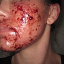 About 6 hours post procedure