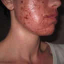 About 30 hours post procedure, lots of swelling