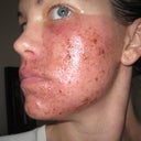 About 60 hours (2.5 days) after procedure