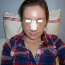 has anyone else gotten severe chipmunk cheeks??? i had almost no dark bruising but my cheeks are like CRAZY swollen.