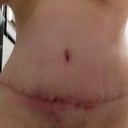 March 19, w/o the gauze