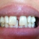 Before photo- spacing issues with front tooth shifting over a bit