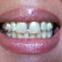 Day 2 with Invisalign appliance in, notice the spacing is kinda camoflaged! amazing!