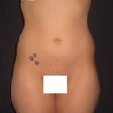 Before OP. Front view..