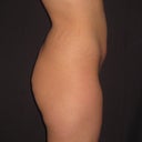 Before OP Side view