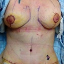 Post op Day 5 - taken while laying flat on back immediately after bandage removal.  Redness is just due to my sensitive skin and rubbing of bra and compression garment.