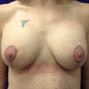 2 weeks post op - right implant (tattoo side) is riding high so massaging it to promote dropping into pocket.
