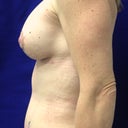 2 weeks post op - hoping the "wavy" profile is due to swelling and will go totally flat