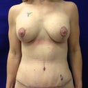 2 weeks post op - still quite swollen and with my drain.  Very happy with the way things look now and how recovery is progressing.