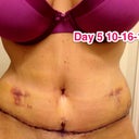 At least my boobs still look good, lol! Still very swollen but doesn't look like a raisin! Yaaaay! Still hunched over.