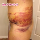 Bruising looks better already, after just 1 day.