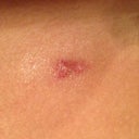 One of my incisions. Putting on my Biocorneum scar treatment cream