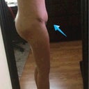 Swelling above and below incision..or???