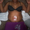 Day 1 Post-op