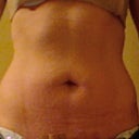 10 days after surgery
