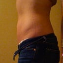 10 days after surgery