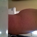 Side view pre tummy tuck