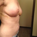 Two weeks post op.  Still some bruising where the lipo was done.