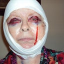 Bled all night. Needed more sutures.