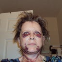 10 days after the surgery