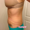 This side still has a fair amount of extra swelling.  This is the side the drain was taken out week 1.