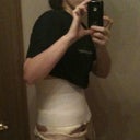 Post op day 2 Yeah, how about that, almost standing straight up!! So glad I wasin shape for this!