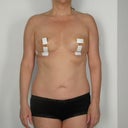 7 days post operation.